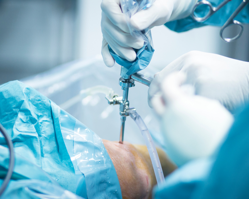 Arthroscopy